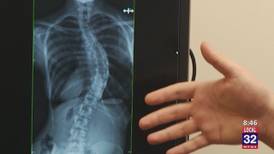 In Good Health: Scoliosis